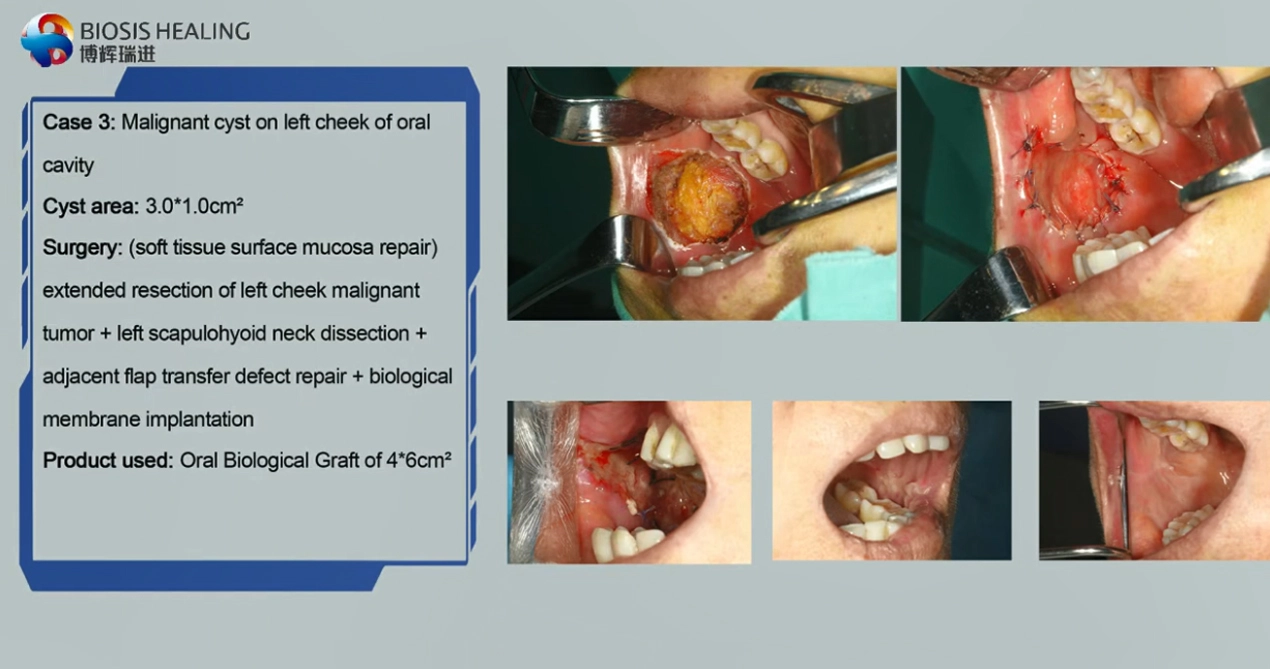 Clincal Cases of Dental Biological Membrane, New SIS Dental Biological Graft