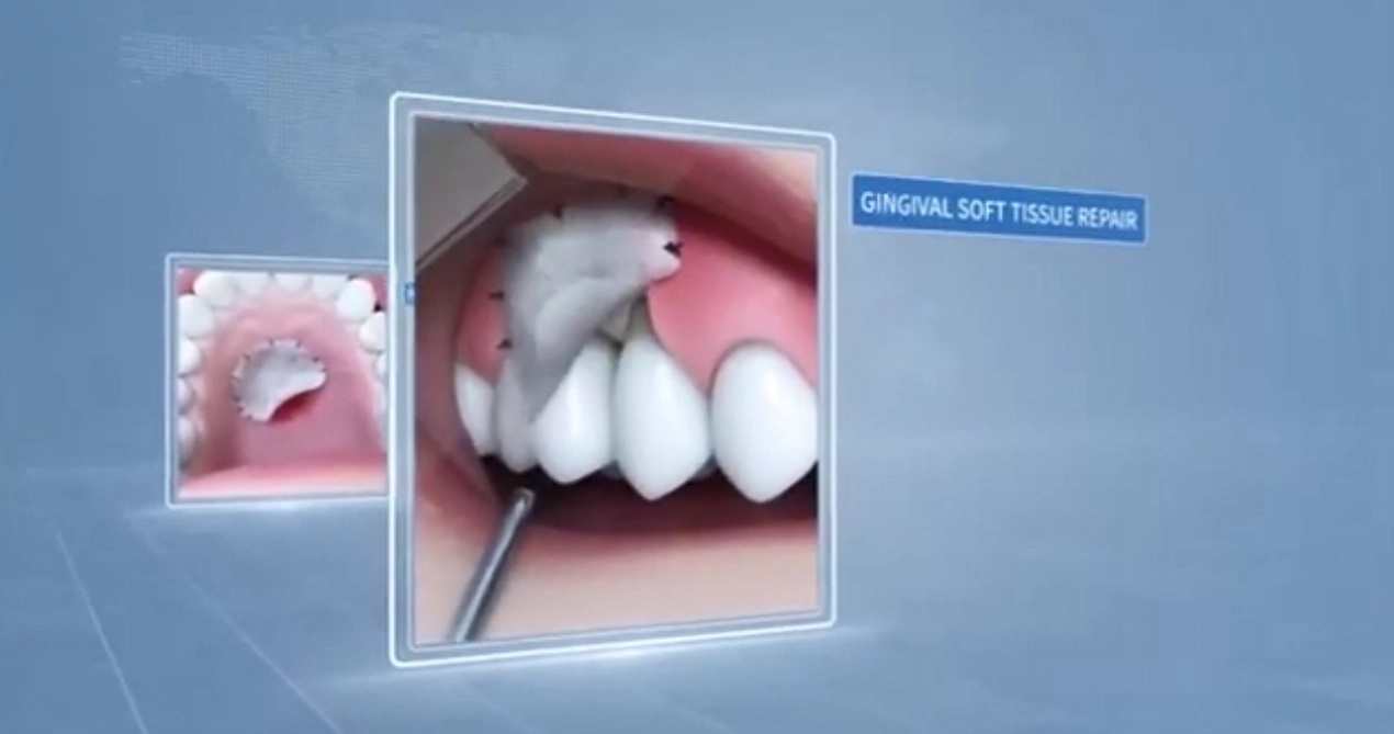 New SIS Dental Biological Graft (Dental Membrane)