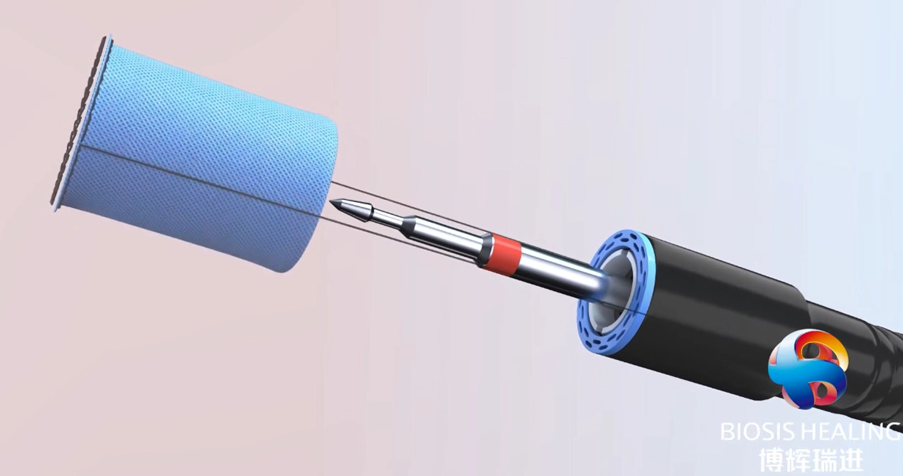 Staple Line Reinforcement for Proximal Gastrectomy