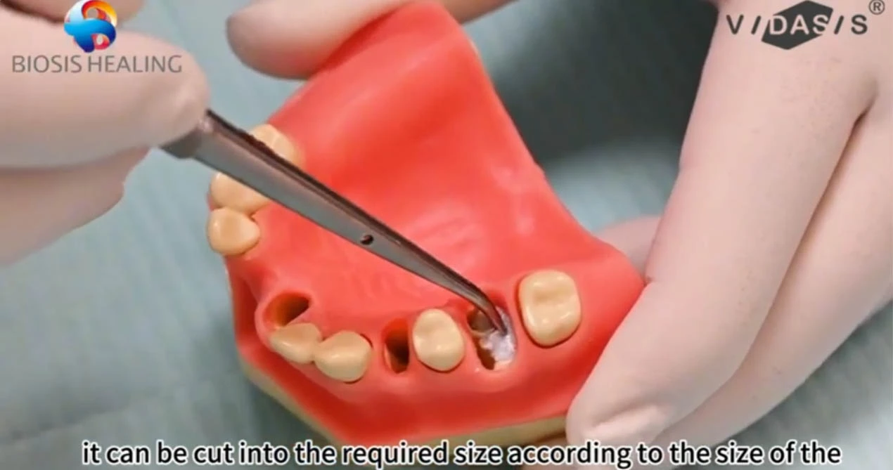 Bone Grafting Material Clinical Application